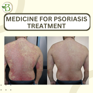 Homeopathic medicine for psoriasis cure